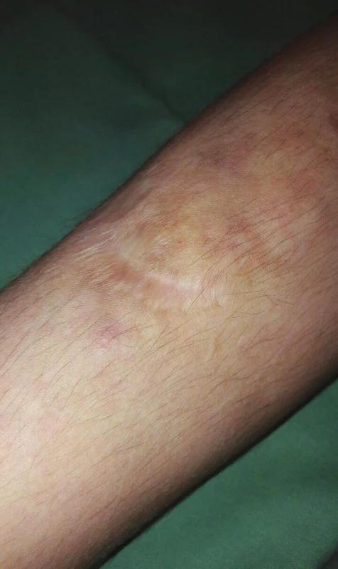 Atrofické rozeklané jizvy a hematomy na bérci