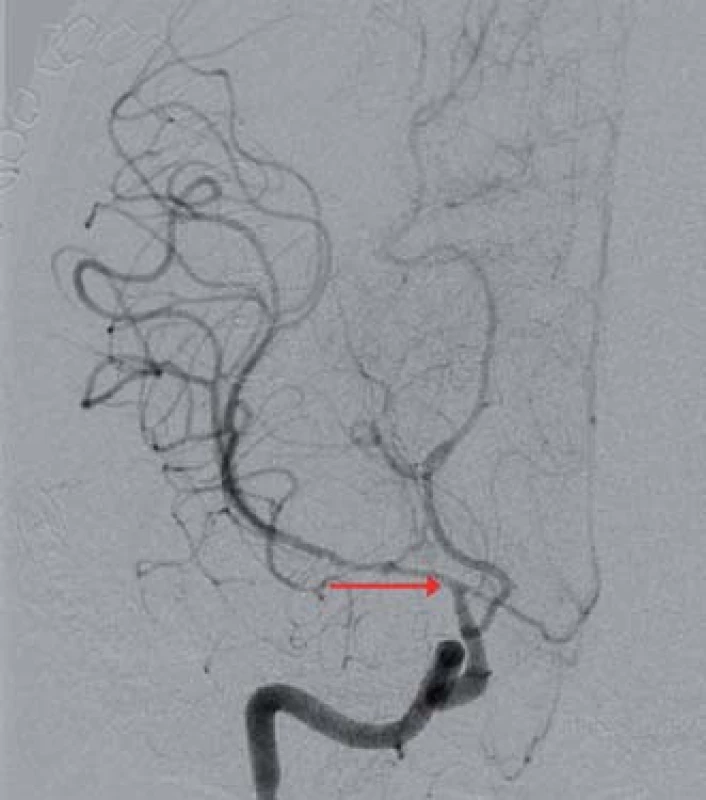 Digitální subtrakční angiografie mozku, koronární projekce, významná stenóza ACI C7 vpravo a dále ACM M1 a ACA A1 vpravo (červená šipka).