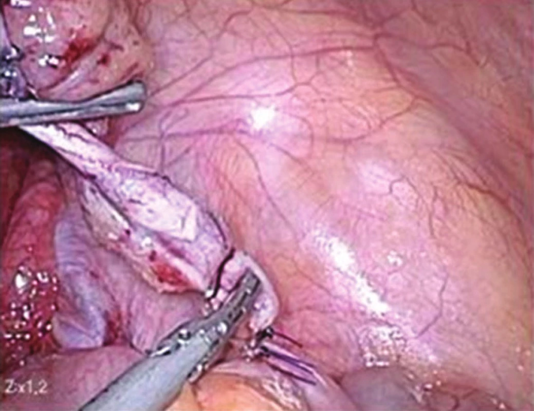 Apendix přetnut nad 2 PDS endo-loopy
Fig. 2: Apendix cut above the 2 PDS endo-loops