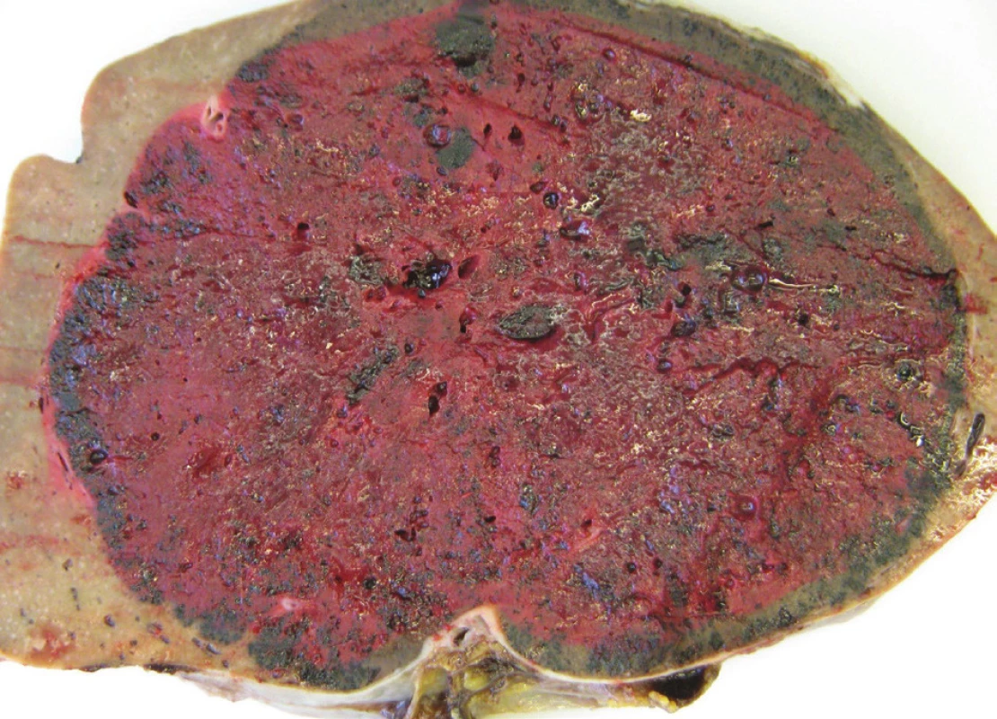 Řez slezinou s patrnou strukturou hamartomu
Fig. 6: Transection of the spleen with apparent hamartoma structure