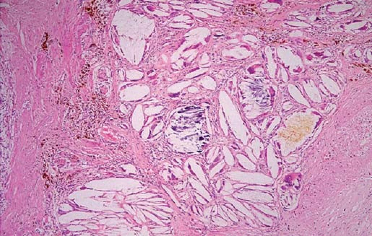 Cholesterolofagický granulom – ložisko sestává z obrovských mnohojaderných buněk, které fagocytují či opouzdřují krystaly cholesterolu (vzhledem k rozpuštění cholesterolu v průběhu zpracování tkáně jsou patrny pouze prázdné prostory). Dále jsou přítomny drobné dystrofické kalcifikace fialové barvy (uprosřed) a malé množství žluté žluči (Hematoxylin-eozin).
Fig. 4. Cholesterol granuloma – the site consists of giant multinucleated cells that are phagocytizing or encapsulating cholesterol crystals (only empty spaces are visible as the cholesterol has melted away during tissue processing). Small purple dystrophic calcifications are also visible (in the middle), as well as a small amount of yellow bile (Hematoxylin and eosin staining).