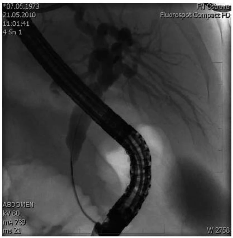 ERCP – nález demonstruje stenózu intrapankreatické části choledochu s prestenotickou dilatací žlučových cest.
Fig. 1. ERCP – the finding demonstrates stenosis of the intra-pancreatic part of the common bile duct.