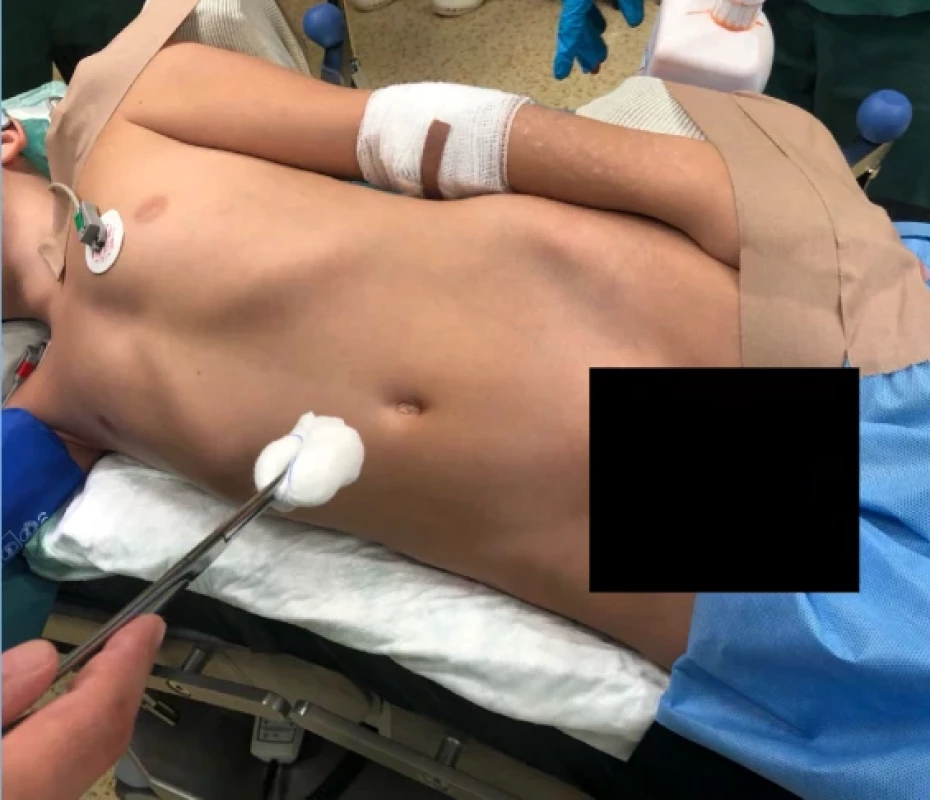 Poloha pacienta na boku na začátku operace. Fig. 1. Patient positioning in the lateral decubitus position at the beginning of the operation.