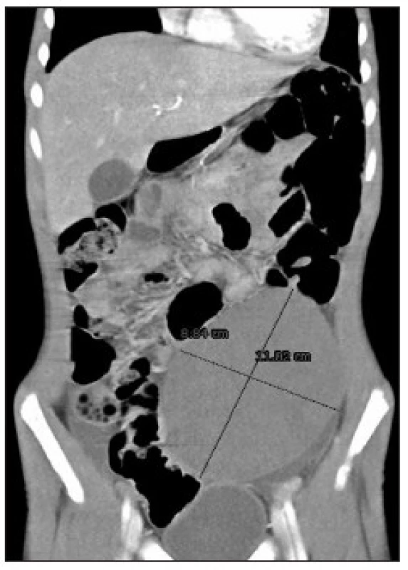 CT obraz dystopickej sleziny sferoidneho tvaru
Fig. 3. CT image of dystopic spheroidal spleen