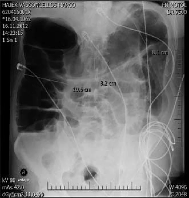 Nativní snímek břicha ve­stoje – megakolon.
Fig. 6. Megacolon (X-rays image).
