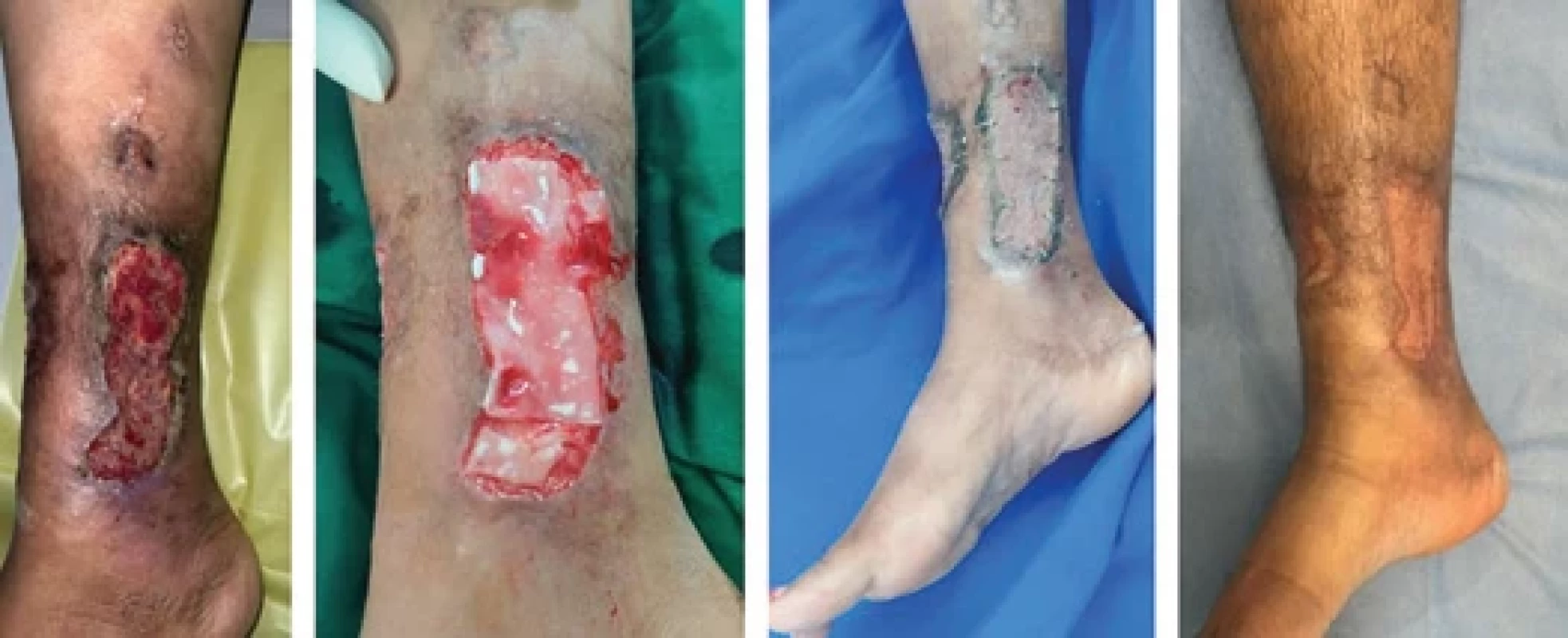 A 40-year-old male with varicose ulcer treated with matrix and SSG had a 100% take at 10th post-operative day and a good scar outcome at 6 months post-operatively.