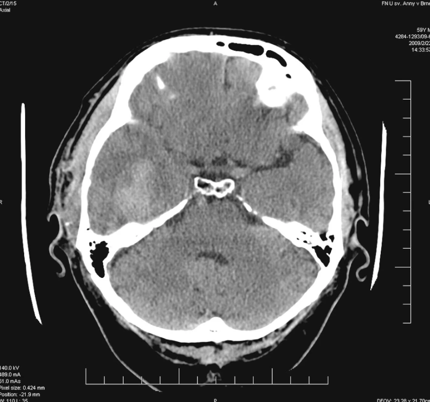 Nález po evakuaci subdurálního hematomu
Pic. 3. Situation after subdural haematoma evacuation