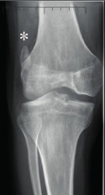 RTG snímek pacienta s nail-patella syndromem – značka určuje laterální pozici hypoplastické pately.
Fig. 5. X-ray of patient with nail-patella syndrome – lateral position of hypoplastic patella marked