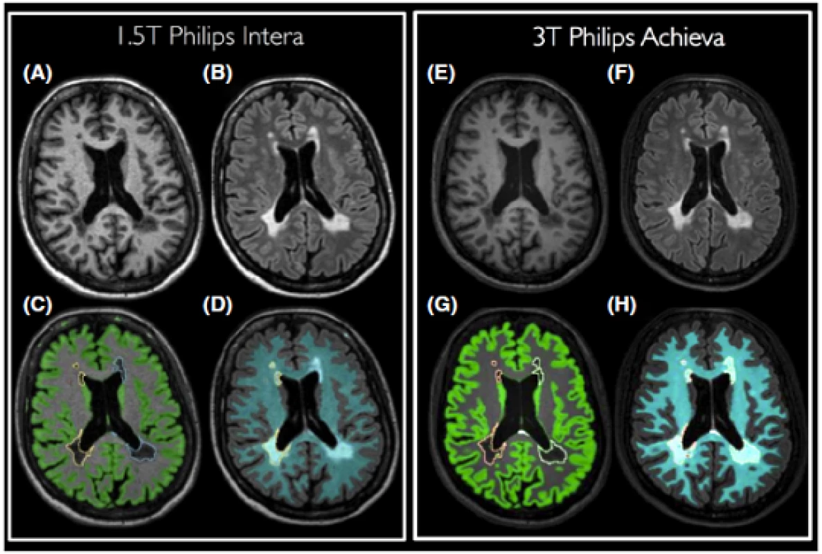 Visualization of MSmetrix segmentation results for the 1.5T (A–D) and 3T (E–H) scan of a randomly selected MS patient. T1 scans are shown in (A) and (E), FLAIR scans in (B) and (F). Lesion and GM segmentations are superimposed on the T1 scan, as displayed in (C) and (G). Finally, lesion and WM segmentations are visualized on the FLAIR scan in (D) and (H).