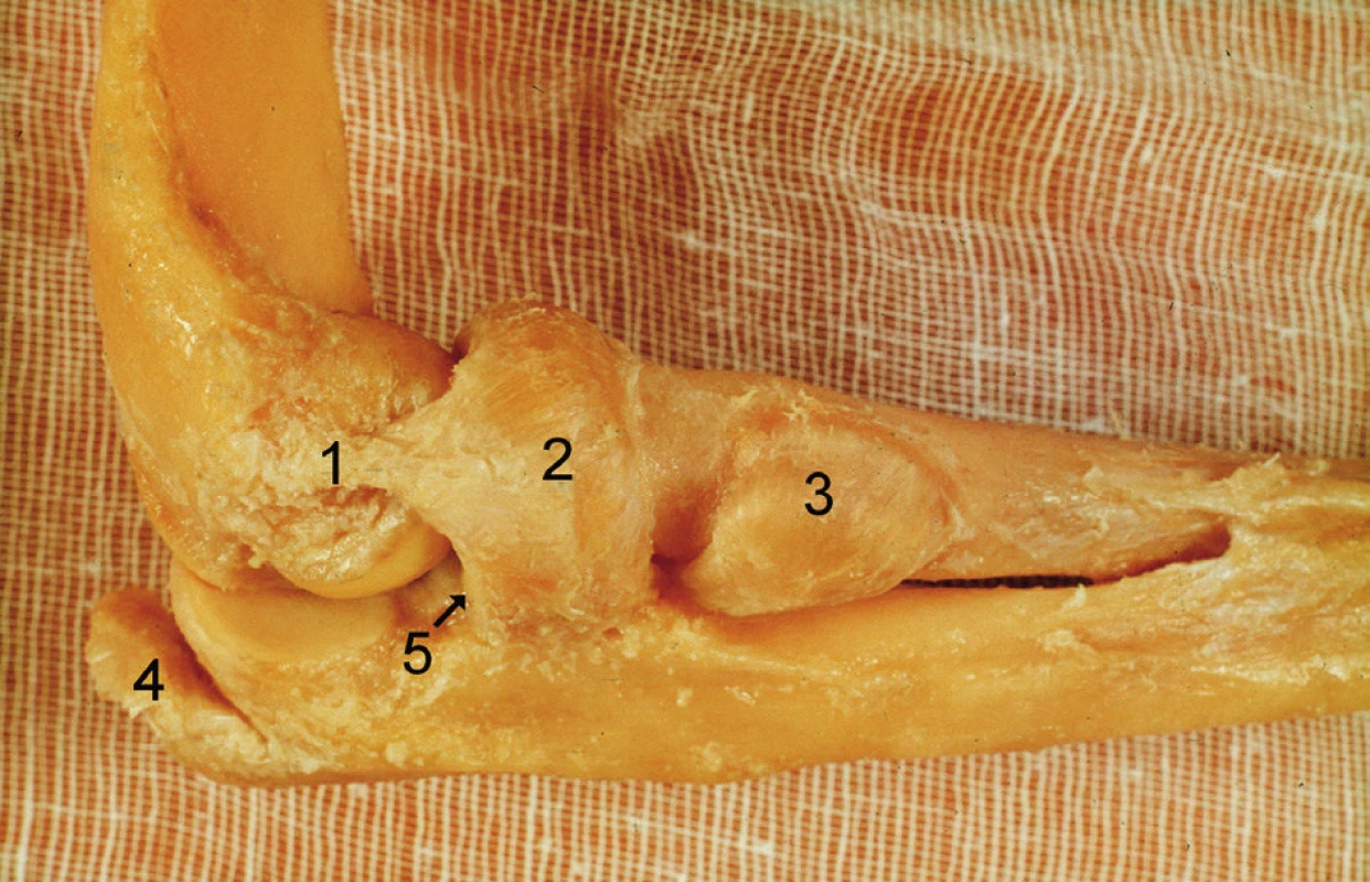Komplex lig. collaterale lat.: 1 – lig. collaterale lat., 2 – lig. anulare radii, 3 – šlacha m. biceps navinutá na pronovaný radius, 4 – šlacha m. triceps brachii, 5 – lig. collaterale lat. ulnare (vlákna lig. collaterale lat. vyzařující do dorzální části lig. anulare). <i>(Převzato z Bartoníček J, Heřt J. Základy klinické anatomie pohybového aparátu. Praha, Maxdorf 2004.)</i>
Fig. 5. Lateral collateral ligament complex: 1 – lateral collateral ligament, 2 – radial annular ligament, 3 – biceps tendon rolled around the pronated radius, 4 – triceps brachii tendon, 5 – lateral ulnar collateral ligament (fibres of the lateral collateral ligament spreading into the posterior part of the annular ligament). <i>(Reprinted from Bartoníček J, Heřt J. [Outline of Clinical Anatomy of Musculoskeletal Apparatus]. Praha, Maxdorf 2004.)</i>