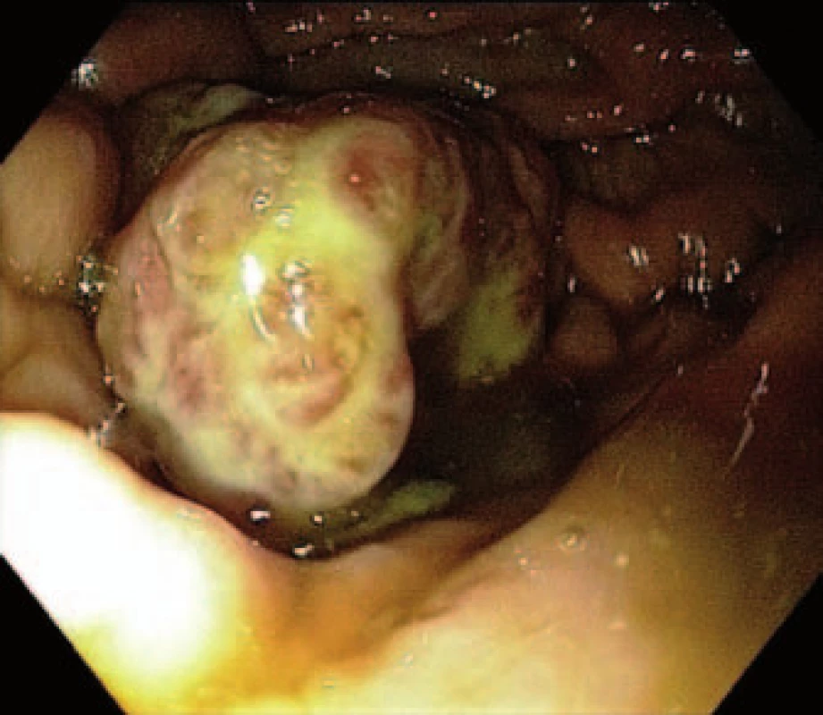 Exulcerovaná metastáza v těle žaludku.
Fig. 1. Exulcerated metastasis in stomach body.