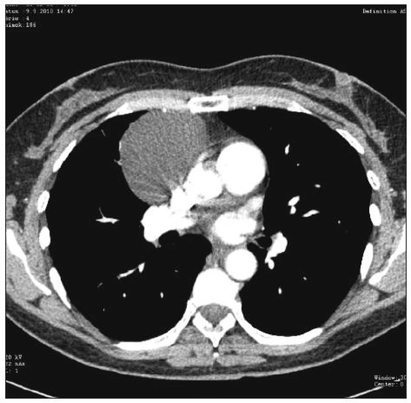 Perikardiální cysta, žena 54 let, operace: VTS / konverze torakotomie – CT obraz
Fig. 1. Pericardial cyst, 54- year old female, procedure: VTS / conversion to thoracotomy – CT view
