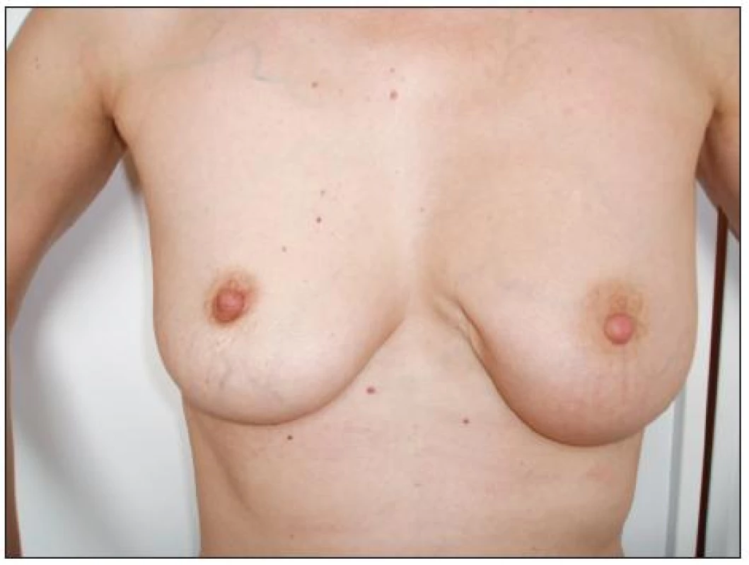 Stav po parciální resekci levého prsu
Fig. 1. The patient’s condition following her left breast resection