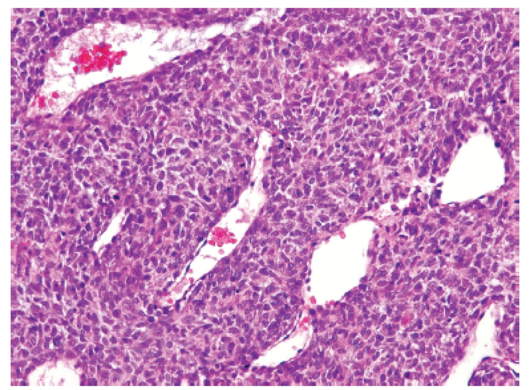 Kazuistika <b>2</b>. Blandně vyhlížející vřetenobuněčný sarkom s bohatou kapilární sítí připomínající nespecifickou <i>HPC-like</i> úpravu např. synoviálního sarkomu či solitárního fibrózního tumoru (HE, 200x).