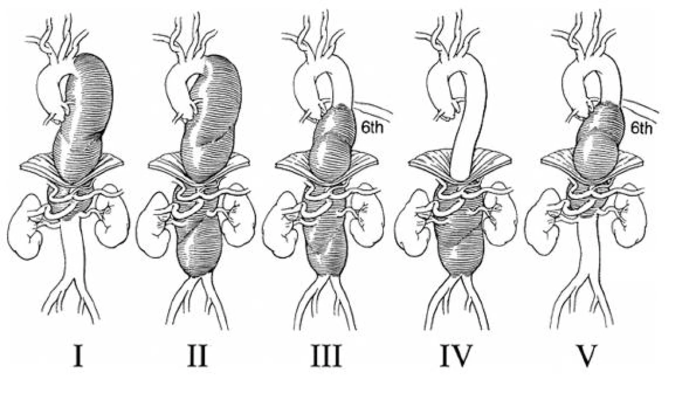 Modifikovaná klasifikace TAAA podle Crawforda
Fig. 1. Modified TAAA classification according to Crawford