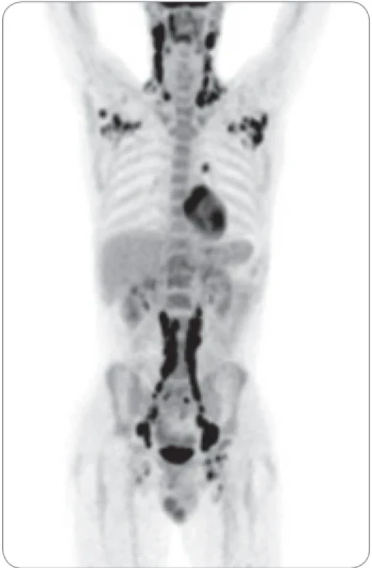 LCH může postihnout lymfatické uzliny, podobně jako známe z lymfomů. PET-CT znázorňuje postižení lymfatických uzlin od krku až po inguiny. LCH z  tohoto pacienta měla neobvykle vysoký proliferační index a vysoký počet mitóz. Onemocnění se chovalo velmi agresivně, takže po remisi navozené lenalidomidem byla provedena alogenní transplantace krvetvorné tkáně a pacient je nyní 8 let v kompletní remisi.