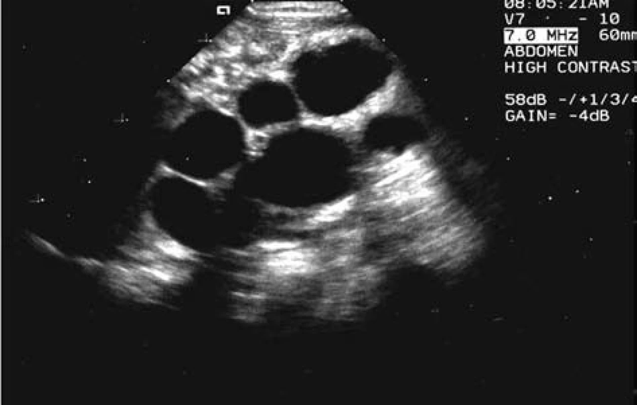 MCDK při stanovení diagnózy u chlapce v novorozeneckém věku.
Fig. 3.MCDK in the determination of diagnosis in a boy of a newborn age.
