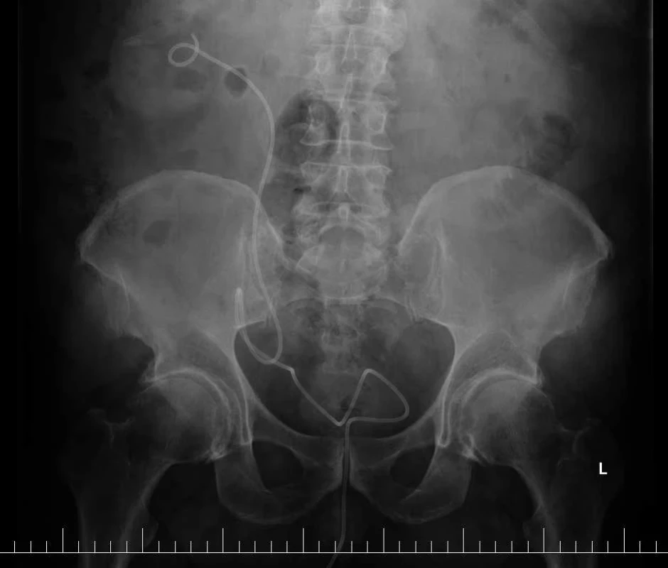 Pooperačné RTG brucha v ľahu pred extrakciou mono J stentu bez známok propagácie močovodu pod úroveň ligamentum inguinale.
