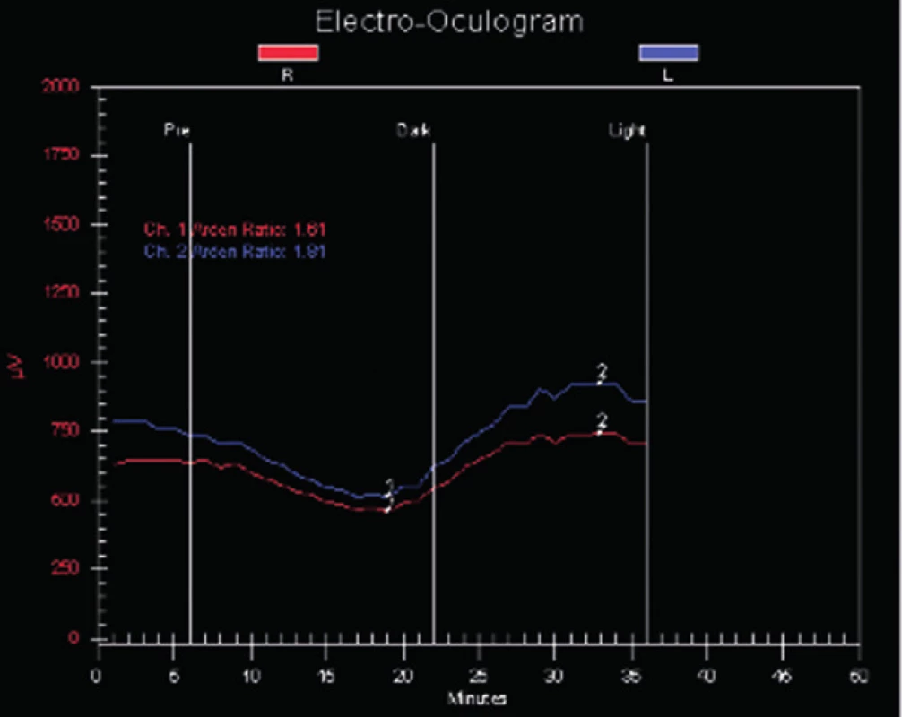 Elektrookulogram