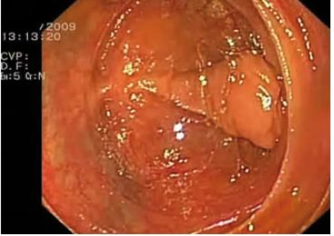Endoskopický pohled do zaslepeného konce přívodné kličky.
Fig. 2. Endoscopic view of blinded end of the afferent loop.