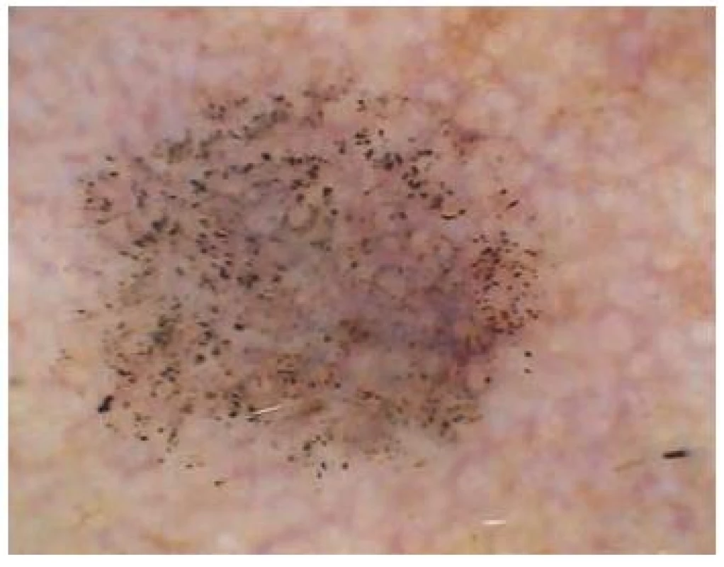 Pigmentovaná varianta keratosis actinica