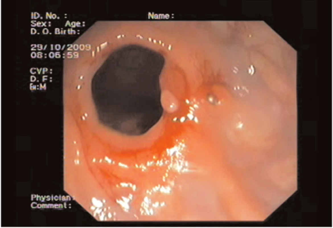 Kolonoskopický nález
Fig. 1: Colonoscopic finding