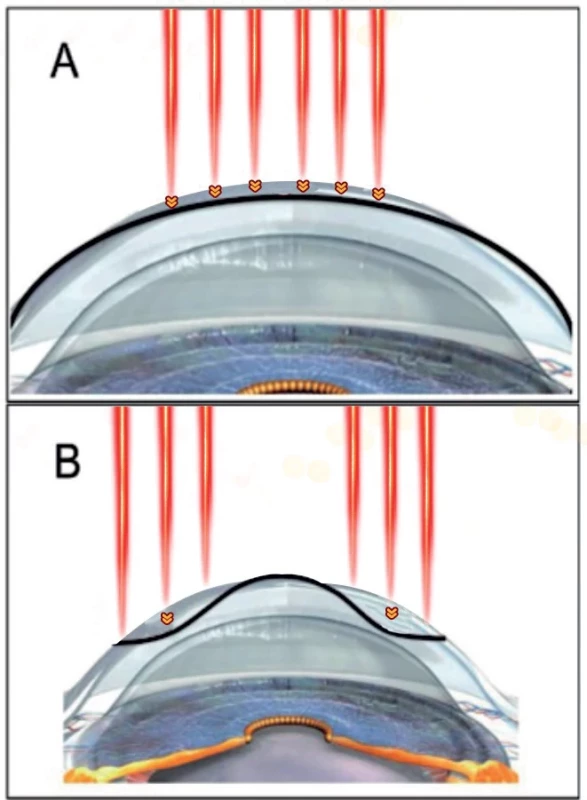 The excimer laser (represented by the red lines) ablates tissue (yellow arrowheads) in the central and paracentral areas (A) to correct myopic errors, and in the periphery of the cornea (B) to correct hyperopic errors