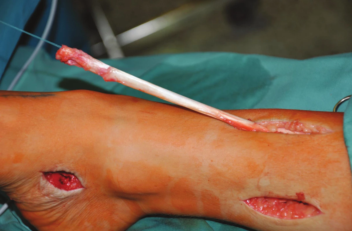 Šlacha m. tibialis posterior po protažení přes interoseální membránu na ventrální stranu bérce
Fig. 2: The posterior tibila tendon inserted through membrana interossea cruris onto the ventral side of the shank