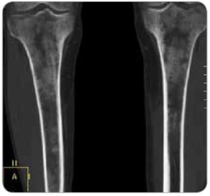 Zobrazení tibie metodou multidetektorového CT , koronární řez. Zřetelná zesílení hydroxyapatitových struktur kortikalis i spongiózy.