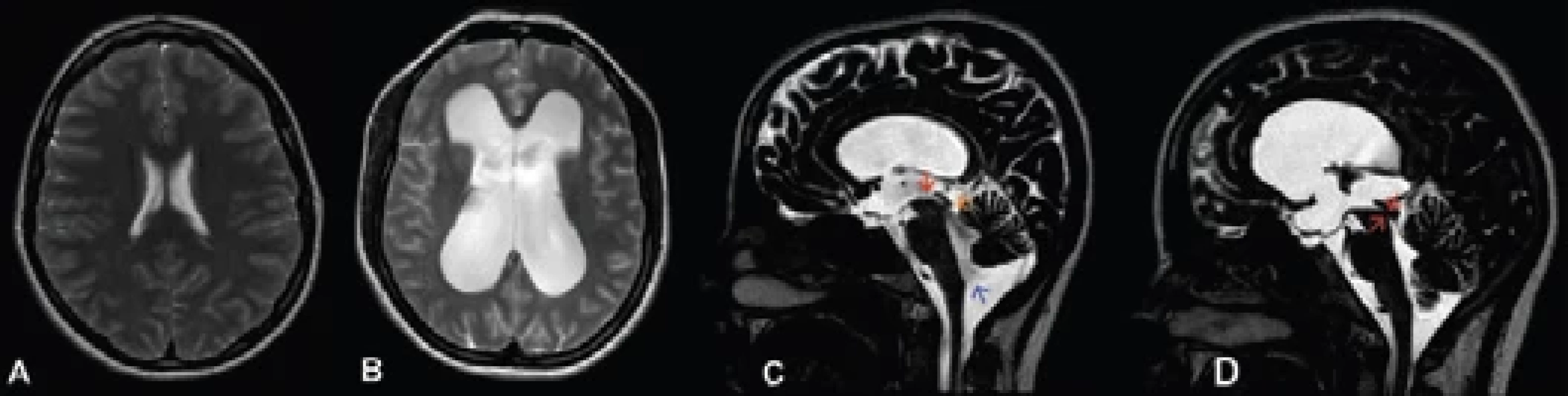 Magnetická rezonance (MR) mozku u pacientek s hydrocefalem.<br>Fig. 1. Magnetic resonance imaging (MRI) of the brain in patients with hydrocephalus.