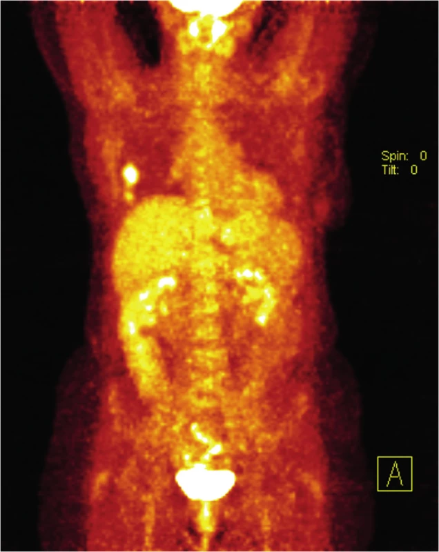 PET/CT vyšetření v říjnu 2012
Fig. 5: PET/CT scan in October 2012