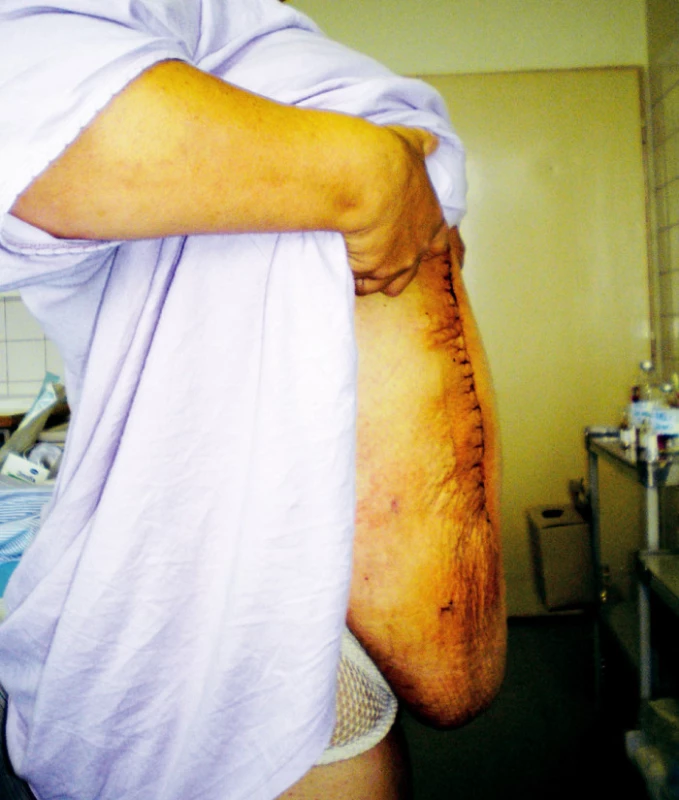 Pooperačný stav 
Fig. 7. Postoperative condition 