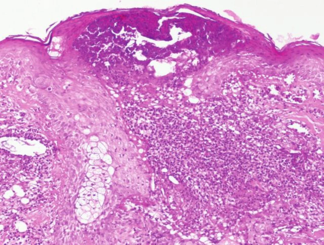 Histologický obraz folikulitidy při léčbě erlotinibem.