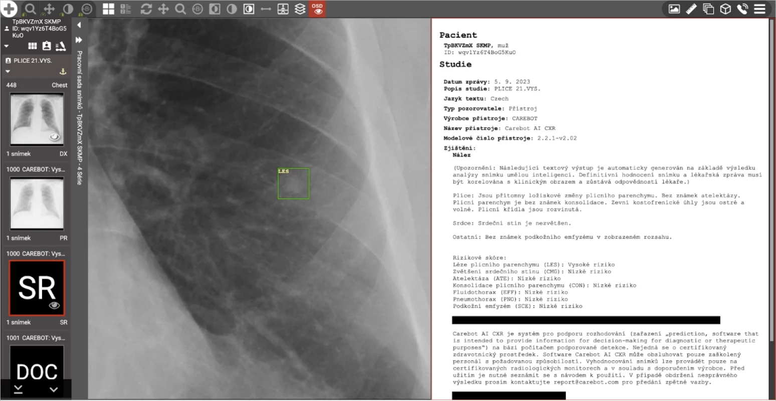 Ukázka výstupu z našeho softwaru Carebot AI CXR ve webovém prohlížeči CloudPACS. 