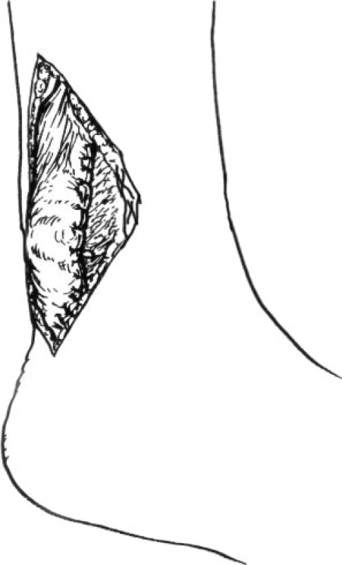 Plastika dle Lynna [6]
(Volně podle Lynn, T.A. Repair of the torn Achilles tendon, using the plantaris tendon as a reinforcing membrane. The Journal of Bone and Joint Surgery, 48A, 268–272, 1966)