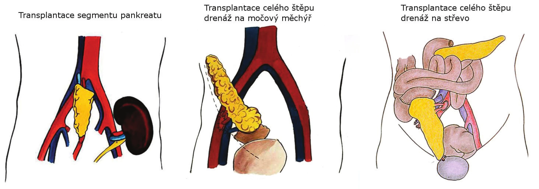 Techniky transplantace pankreatu používané v IKEM
Fig. 1. Pancreas transplantation techniques used in IKEM