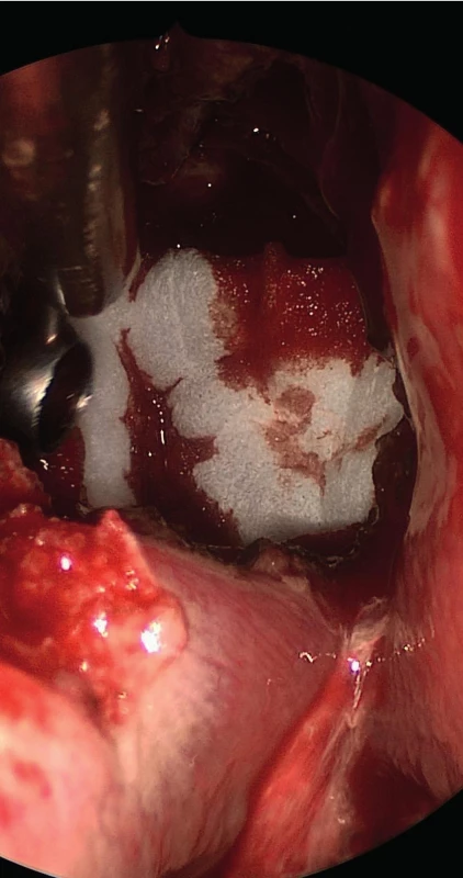 Plastika defektu umělou plenou
Fig. 4: Duroplasty using artificial dura mater