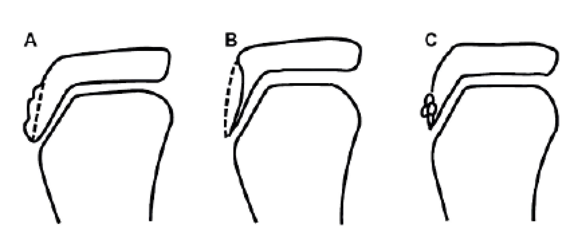 Závažnost OS dle RTG nálezu: A) změna nebo lehká elevace tuberositas tibiae;  
B) radiolucence tuberositas tibiae; C) fragmentace tuberositas tibiae (8).