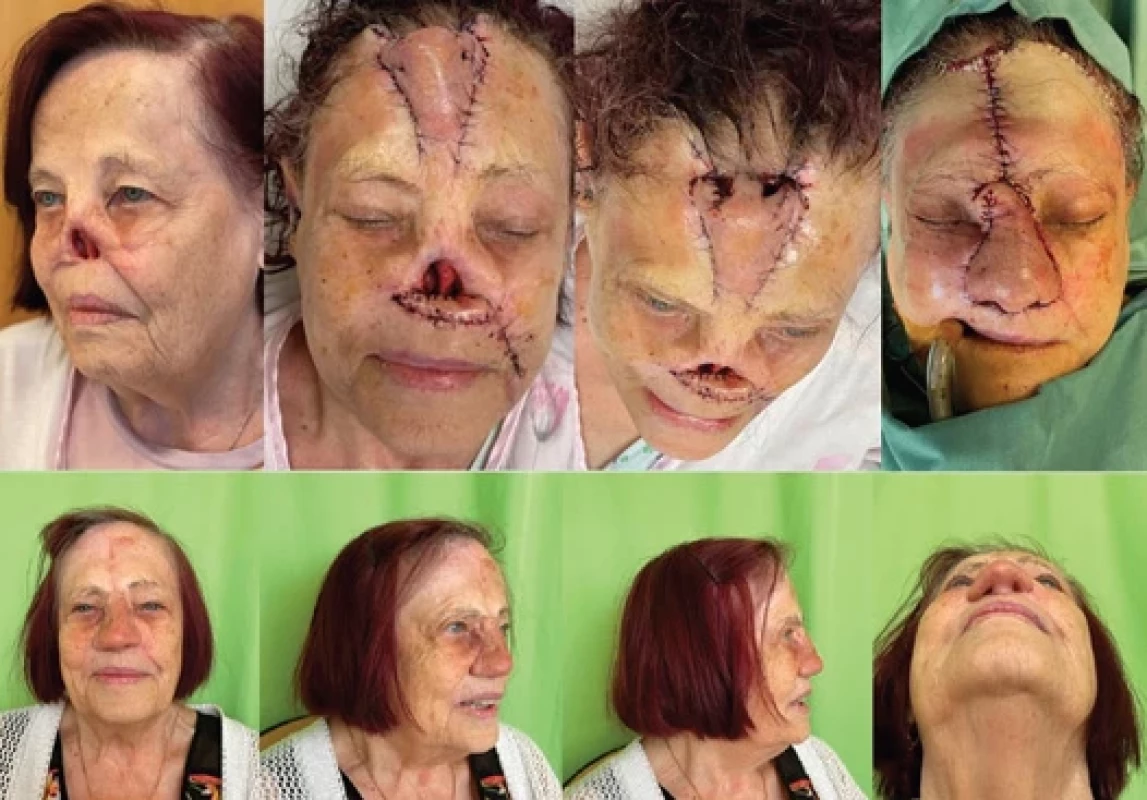 Prelaminated frontal fl ap and its transfer to the nose reconstruction. (Source: photo archive of the author).