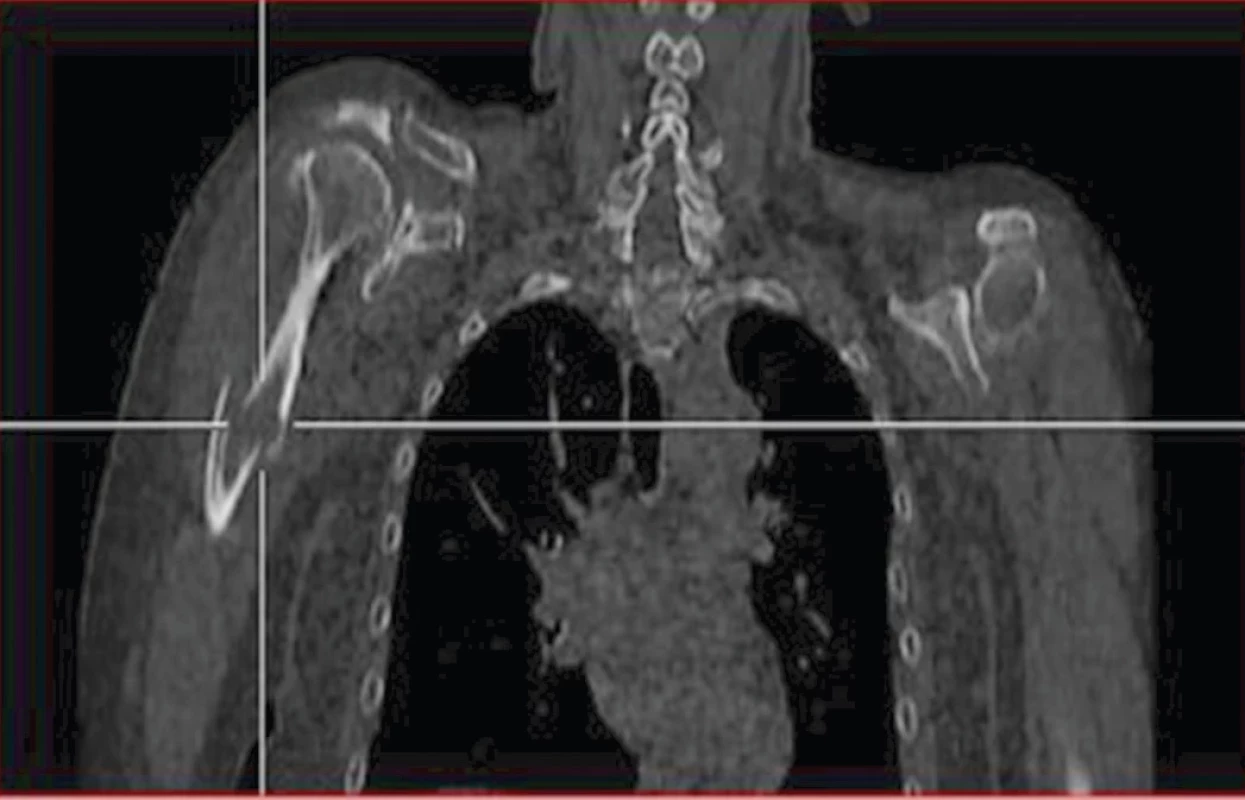 LDCT hrudníku v koronárním řezu – patologická fraktura na podkladě osteolytické metastázy v proximální třetině pravého humeru a osteolytická metastáza v pravém glenoidu.