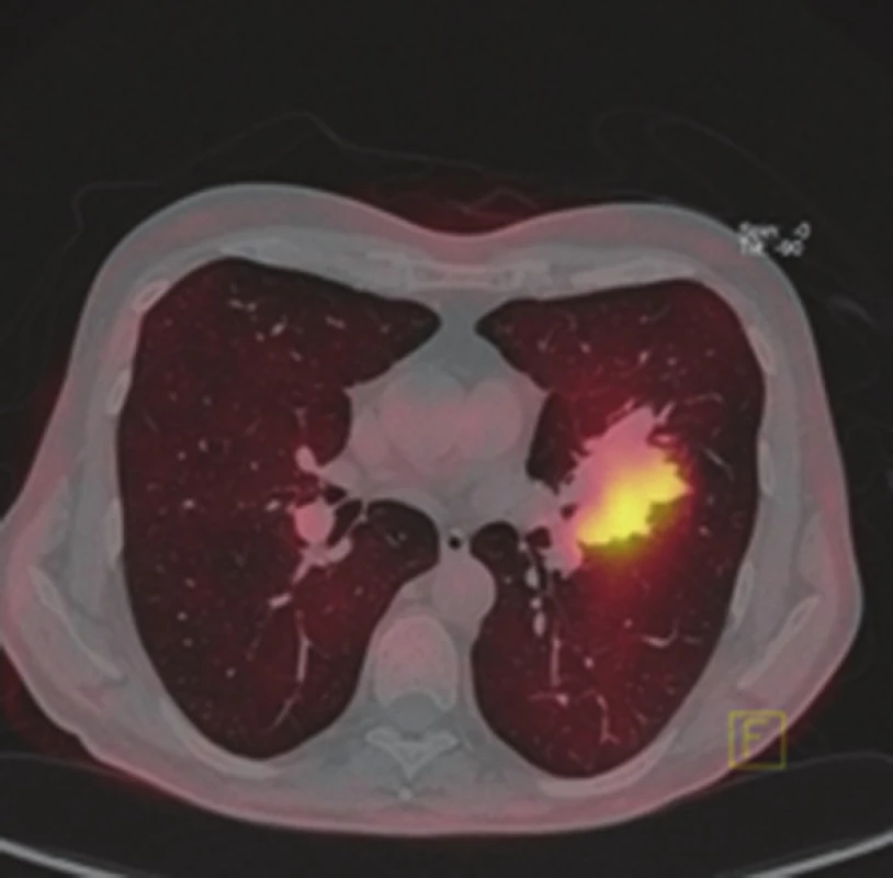 PET/CT hybridní obraz metabolicky aktivní metastázy hilu levé plíce (axiální řez)
Fig. 4: PET/CT hybrid scan of a metabolic active pulmonary metastasis (hilum of the left lung, axial view)