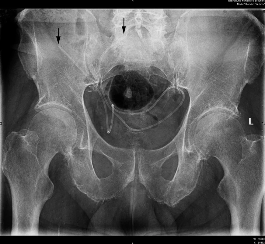 Na rentgenovém snímku je vidět rozpojený peritoneální katetr dislokovaný do dutiny břišní (konce označeny černými šipkami)
Fig. 3: Migration of a disconnected peritoneal catheter into the abdominal cavity (ends marked with black arrows) on the x-ray image