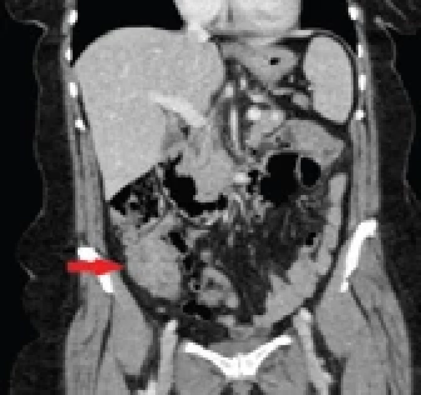 CT zobrazující dolichotransversum s tumorózní infi ltrací v pravém podbřišku délky 6 cm.