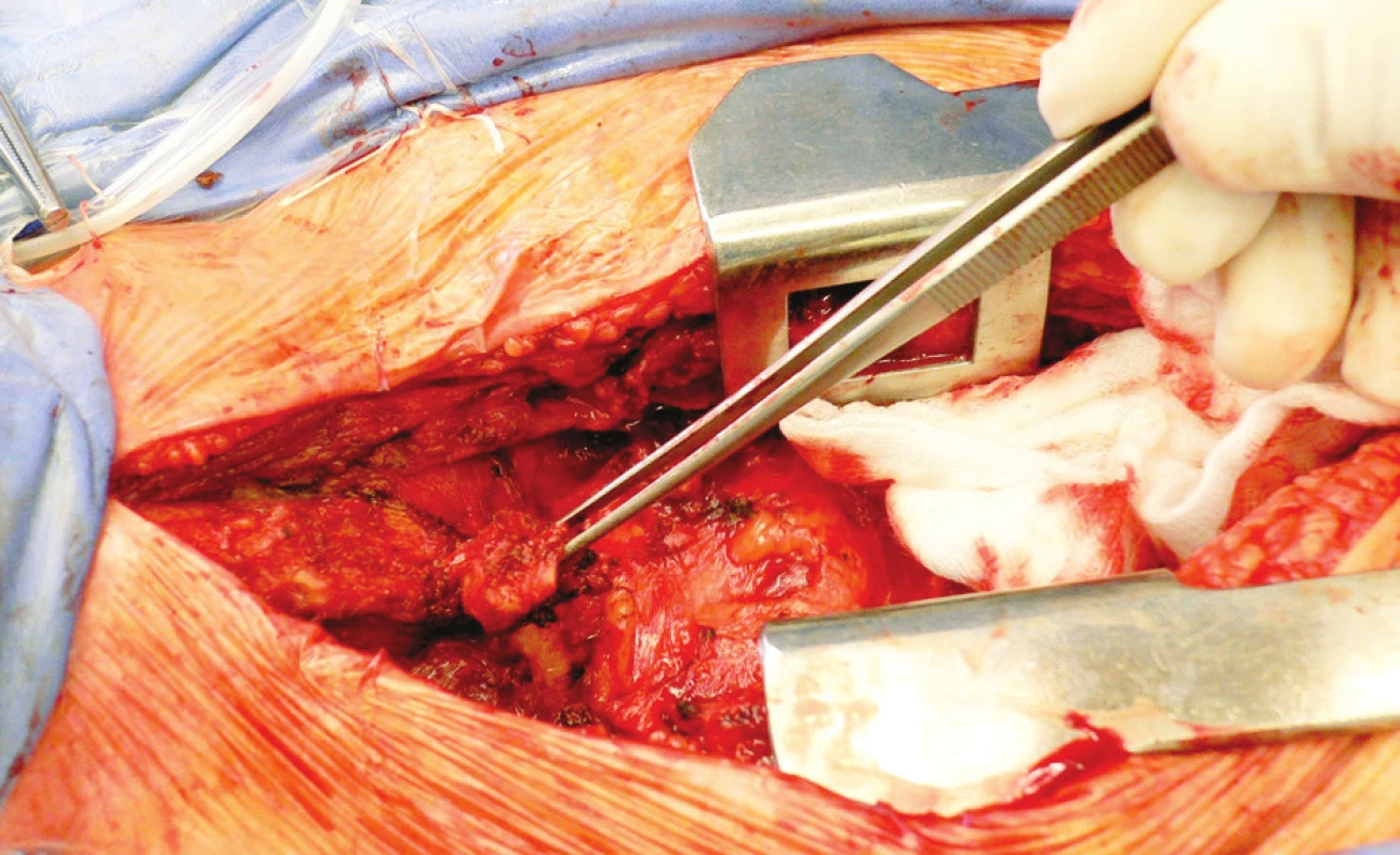 Preparácia v okolí trachey, osifikačné ložisko odpreparované od trachey v pinzete (pacient č. 5)
Fig. 6. Preparation near the trachea, an ossification focus, detached from the trachea held in the pincers (patient No 5)