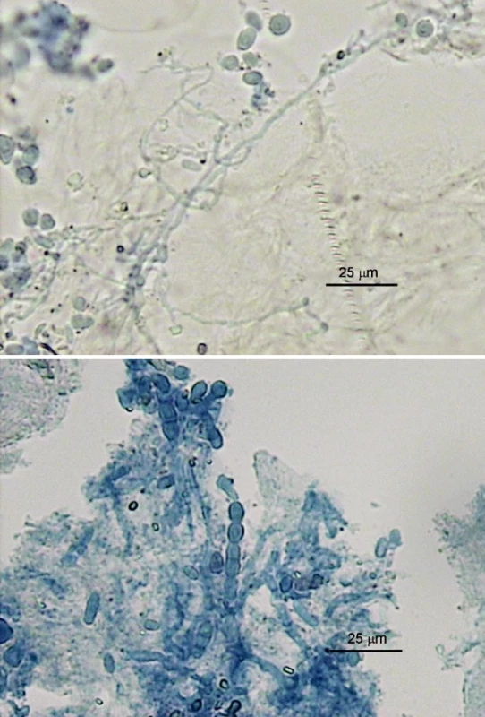 a, b. Mikroskopické nálezy v nechtoch pacientov (preparáty v KOH s Parker black ink); a) tenšia rozvetvená hýfa a oválne artrokonídiá, b) širšie polámané hýfy, artrokonídiá jednotlivo a v retiazkach (foto A.V.)
Fig. 1 a, b. Microscopy nail findings (potassim hydroxide and Parker black ink mounts); a) thin-walled hyphal branches and oval arthroconidia, b) thicker-walled hyphal fragments, single arthroconidia and arthroconidial chains (photo A.V.)