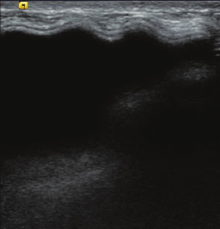 USG – zvlněný implantát vlevo
Fig. 1: USG – Undulation of left breast silicone implant