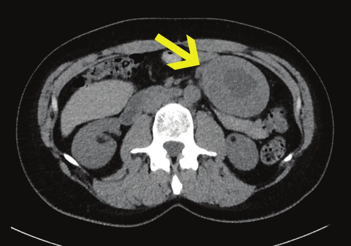 CT s tumorem v levém mezogastriu, axiální řez
Fig. 3: CT scan with tumour in the left mesogastrium, axial section