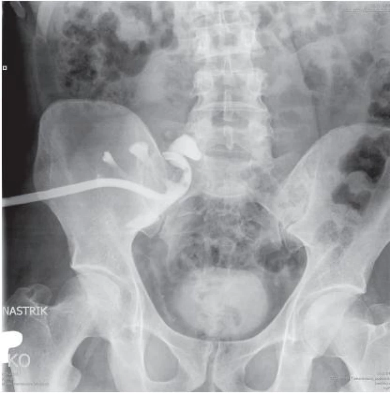 Pooperační nefrostomogram
Fig. 2. Postoperative nephrostomogram