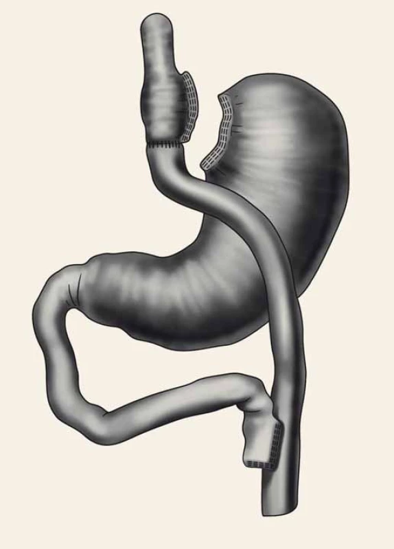 Roux-Y gastrický bypass.
Fig. 1. Roux-Y gastric bypass.