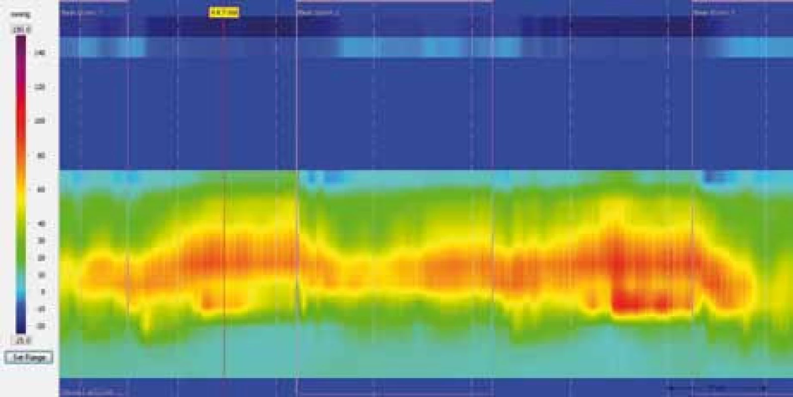 Barevná škála k zobrazení analyzovaných intraluminálních tlaků při HRAM.
Fig. 1. Color scale for depict of intraluminal pressure in HRAM.